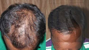 HAIR TRANSPLANT