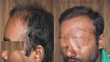 HAIR TRANSPLANT