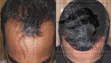 HAIR TRANSPLANT