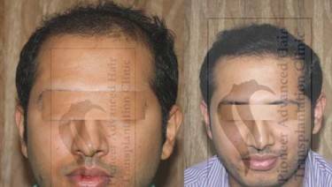 HAIR TRANSPLANT