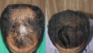 HAIR TRANSPLANT
