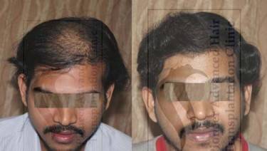 HAIR TRANSPLANT