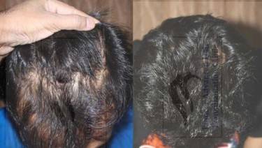 HAIR TRANSPLANT
