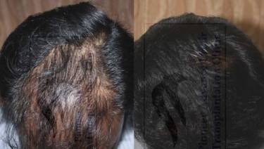 HAIR TRANSPLANT