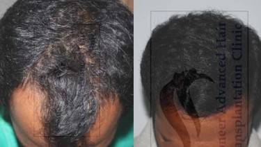 HAIR TRANSPLANT