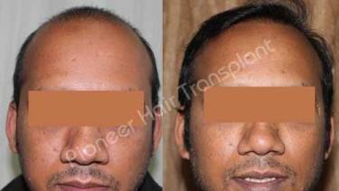 HAIR TRANSPLANT