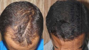 HAIR TRANSPLANT