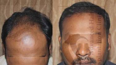 HAIR TRANSPLANT