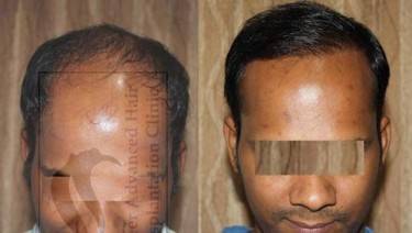 HAIR TRANSPLANT