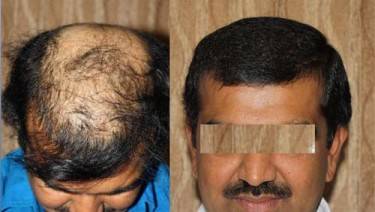 HAIR TRANSPLANT