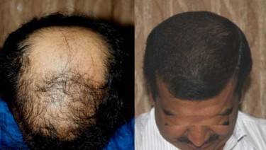 HAIR TRANSPLANT