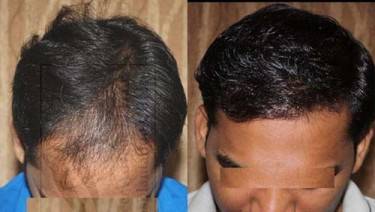 HAIR TRANSPLANT