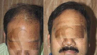 HAIR TRANSPLANT