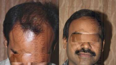 HAIR TRANSPLANT