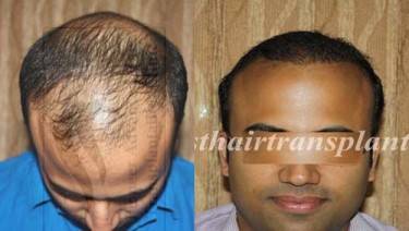 HAIR TRANSPLANT