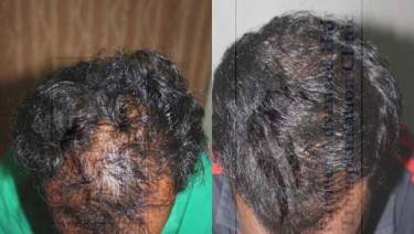 HAIR TRANSPLANT