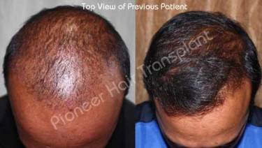 HAIR TRANSPLANT