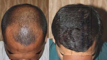 HAIR TRANSPLANT