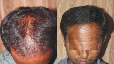 HAIR TRANSPLANT