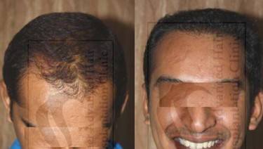 HAIR TRANSPLANT