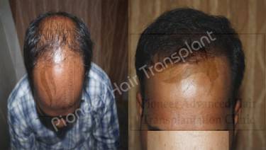 HAIR TRANSPLANT