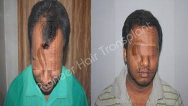 HAIR TRANSPLANT