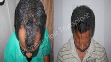 HAIR TRANSPLANT