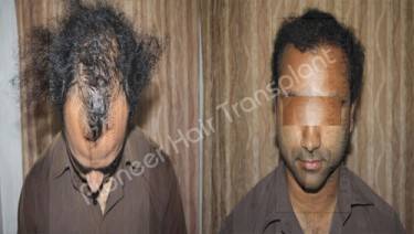HAIR TRANSPLANT