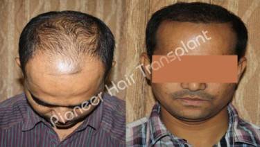 HAIR TRANSPLANT