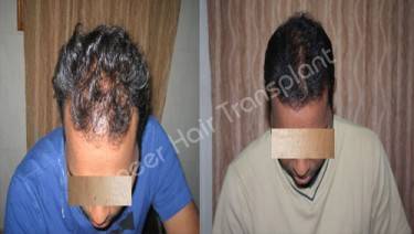 HAIR TRANSPLANT