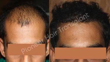 HAIR TRANSPLANT
