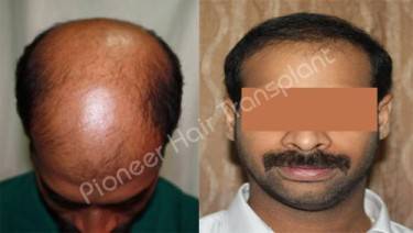 HAIR TRANSPLANT