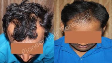 HAIR TRANSPLANT