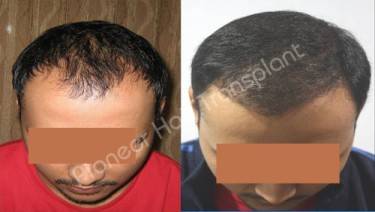 HAIR TRANSPLANT