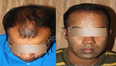 HAIR TRANSPLANT