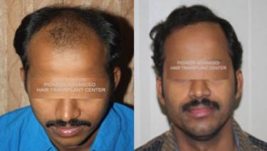 HAIR TRANSPLANT