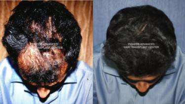 HAIR TRANSPLANT