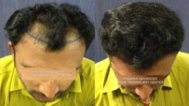 HAIR TRANSPLANT