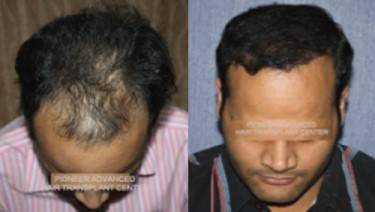 HAIR TRANSPLANT