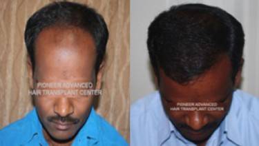 HAIR TRANSPLANT