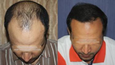 HAIR TRANSPLANT