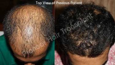 HAIR TRANSPLANT