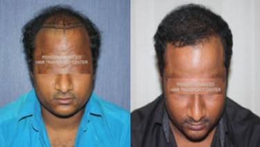 HAIR TRANSPLANT