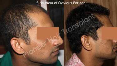 HAIR TRANSPLANT