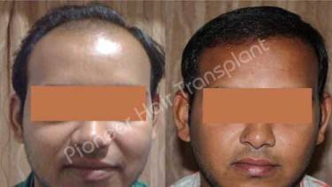HAIR TRANSPLANT