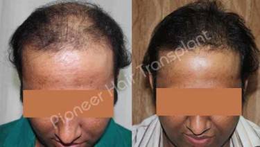 HAIR TRANSPLANT