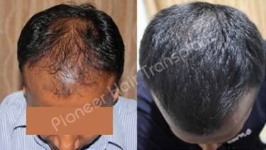HAIR TRANSPLANT