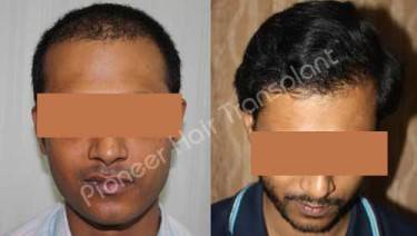 HAIR TRANSPLANT