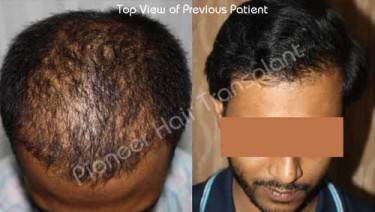HAIR TRANSPLANT