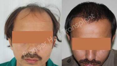 HAIR TRANSPLANT